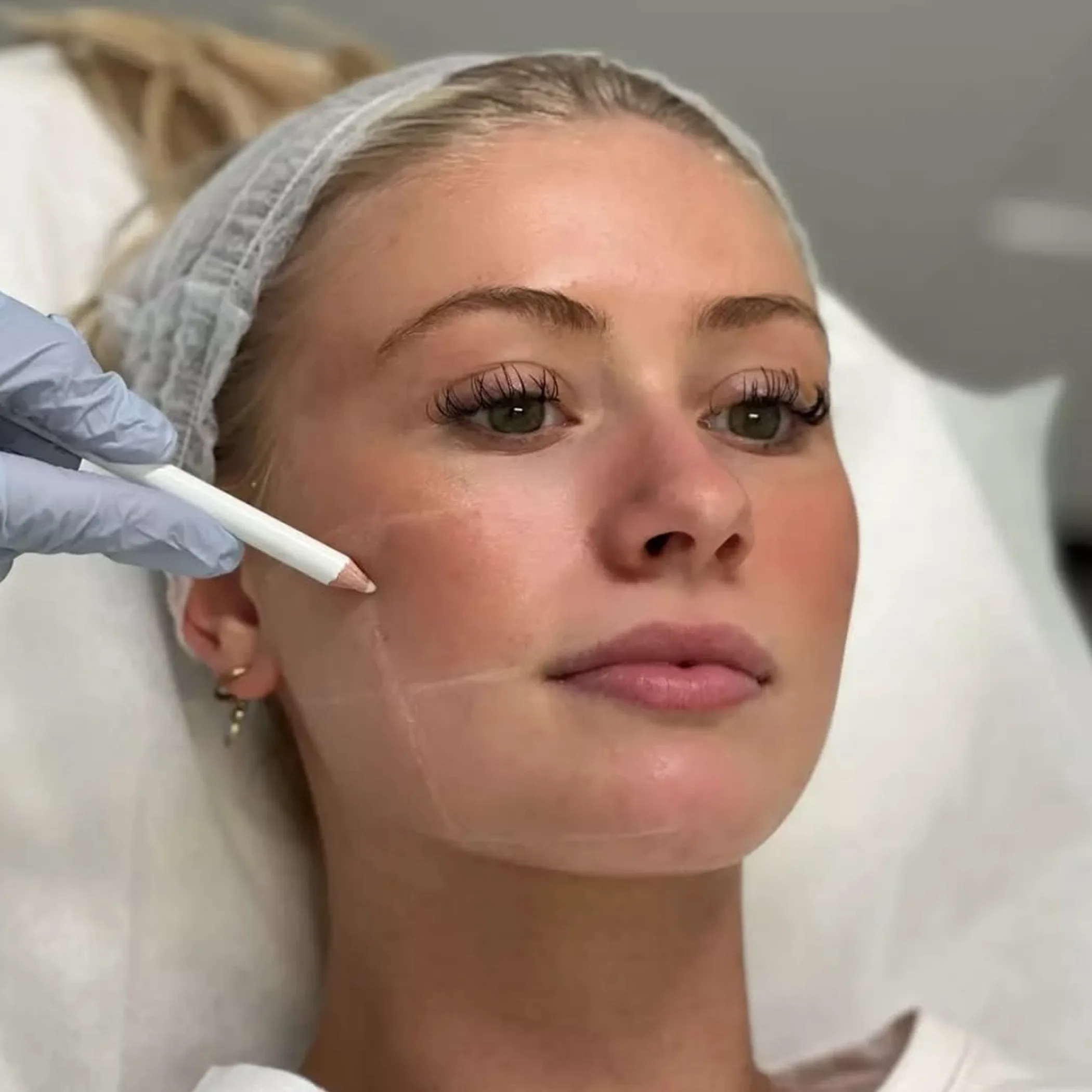 skin marking before cosmetic treatment